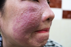 Hiểm họa từ “mỹ phẩm thảo  dược thiên nhiên”