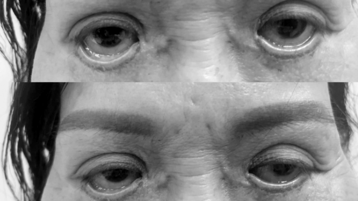 Mắt trợn ngược sau cắt mí ở spa