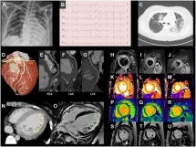 Ca bệnh điển hình chứng tỏ ngoài phổi, COVID-19 còn tổn hại tới tim
