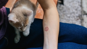 Một số bệnh về da khi thời tiết chuyển mùa