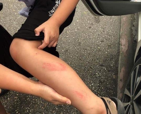 Cô giáo tát học sinh lớp 2 bầm tím bị đình chỉ công tác