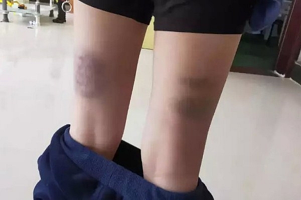 Bố mẹ sốc nặng vì con trai bị thầy giáo “tra tấn” bằng 100 roi bo me soc nang vi con trai bi thay giao tra tan bang 100 roi