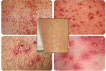 Trời nóng, dễ viêm nang lông