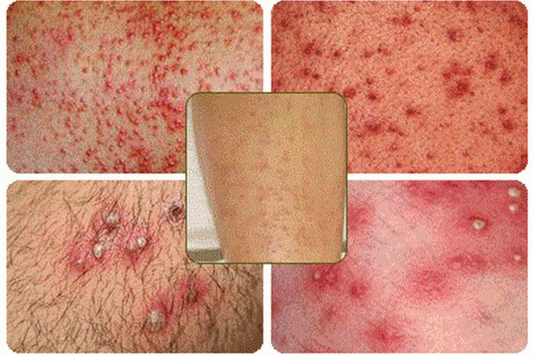 Trời nóng, dễ viêm nang lông