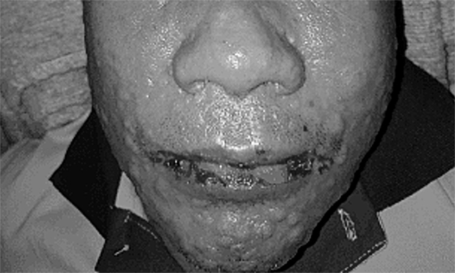 Người đàn ông trợt da khắp người sau khi uống thuốc trị gout