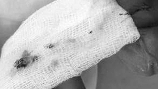 Nam thanh niên bị liệt dương sau khi chữa yếu sinh lý