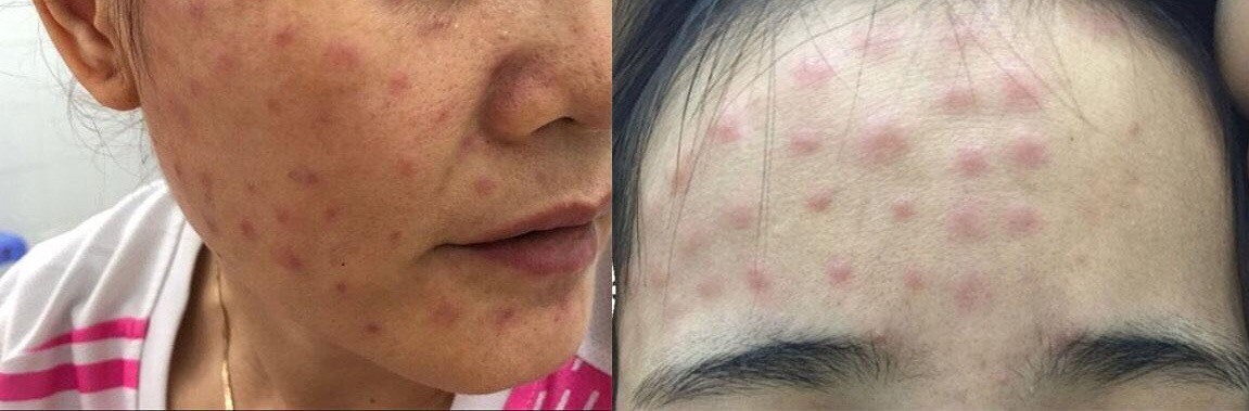 Em gái tiêm tế bào gốc từ spa của chị ruột rồi tá hoả khi da nổi sần đỏ