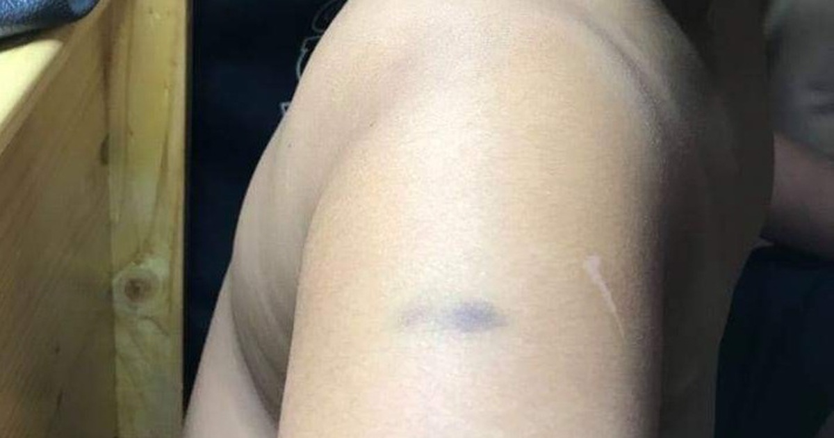 Cô giáo trường quốc tế đánh học trò bầm cánh tay