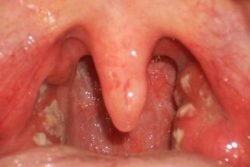 5 biện pháp cần thực hiện để phòng bệnh bạch hầu