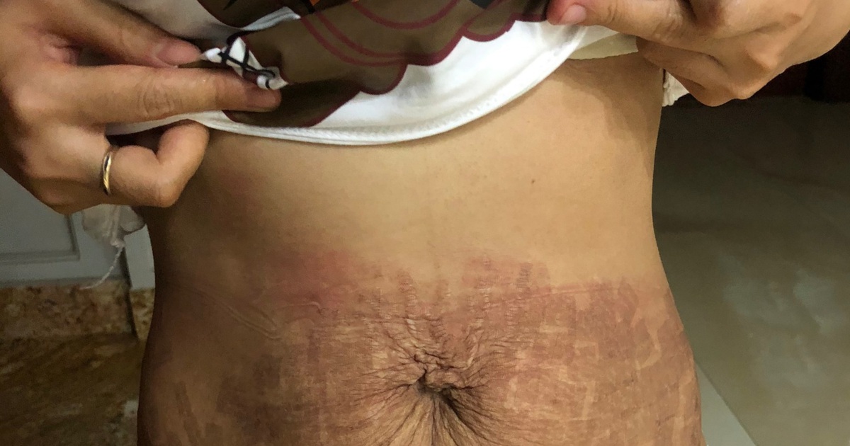 Thẩm mỹ viện “ma” dùng tế bào gốc dỏm làm “cháy” bụng bệnh nhân