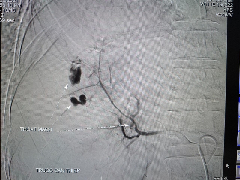 30 phút nút mạch cứu bệnh nhân vỡ gan phức tạp, không cần phẫu thuật