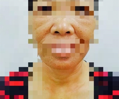 Chớ để da bị "cháy nắng" vì có thể dẫn đến ung thư da