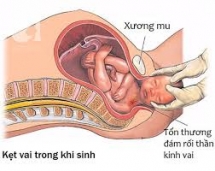 Sinh khó do kẹt vai - Tai biến sản khoa đáng sợ và bi thảm nhất