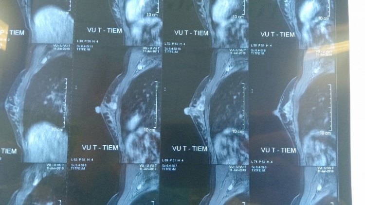Chuyên gia đầu ngành cảnh báo tình trạng "trẻ hóa" ở bệnh nhân ung thư vú