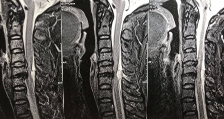 Đi giác hơi, nắn bóp, người phụ nữ đột ngột bị liệt nửa người Đi giác hơi, nắn bóp, người phụ nữ đột ngột bị liệt nửa người