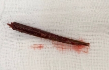 Đi ăn cỗ cưới, nam thanh niên bị bạn dùng que xiên thịt đâm thủng tuỷ sống