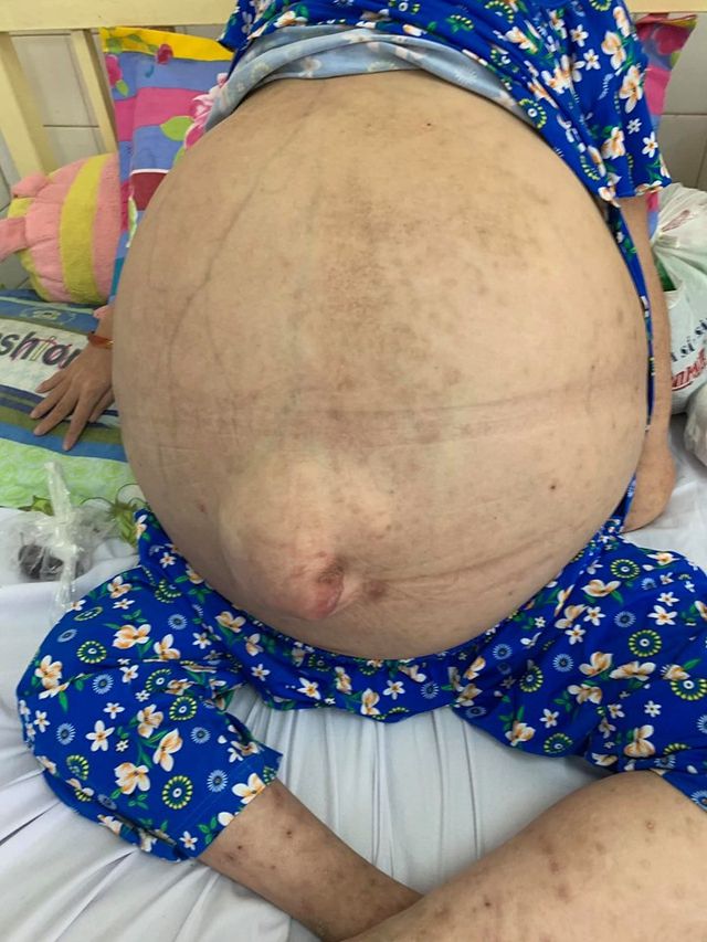 nu benh nhan 19 tuoi mang khoi buou khong lo nhu enh uong