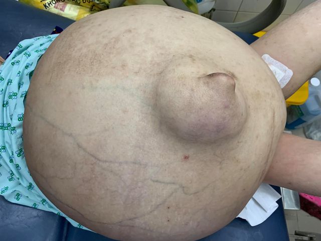 nu benh nhan 19 tuoi mang khoi buou khong lo nhu enh uong