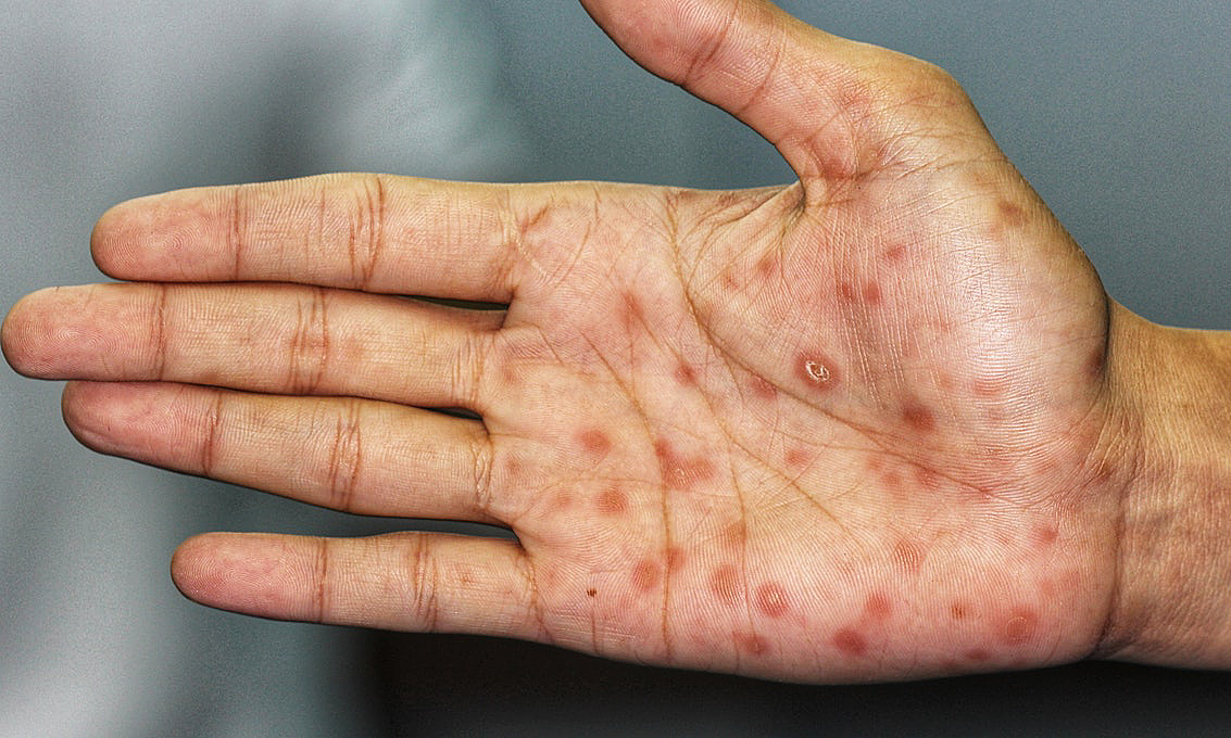 Bé trai 13 tuổi ở Hà Nội mắc bệnh giang mai