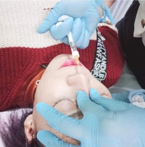 Bị hoại tử vì bơm chất làm đầy tại các cơ sở không phép