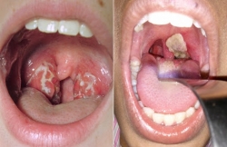 Tại sao bệnh bạch hầu có thể gây tử vong và thời gian tử vong ra sao?