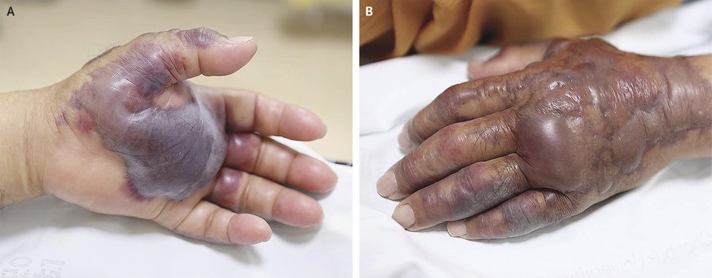 Những đường lây nhiễm "vi khuẩn ăn thịt người" nhiều người không biết