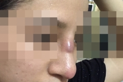 Nâng mũi thẩm mỹ tại spa, nữ sinh suýt thủng vách mũi