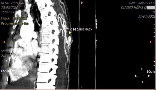 Nặn mụn ở lưng, thanh niên 18 tuổi đi cấp cứu vì máu “phun” thành tia - 1