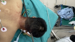 Nam thanh niên bị thanh sắt xuyên thấu từ cổ qua não