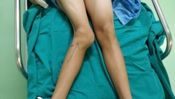 Tăng nặng biến dạng khớp gối vì ngại tái khám do Covid-19