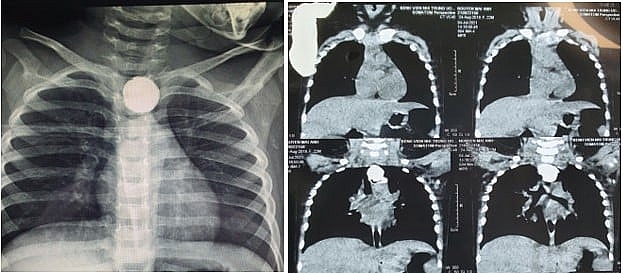 Bé 22 tháng tuổi viêm phổi nặng, rò khí thực quản vì nuốt phải pin