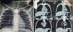 Bé 22 tháng tuổi viêm phổi nặng, rò khí thực quản vì nuốt phải pin