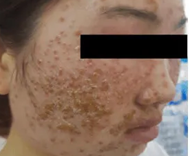 Sốc với mảng mụn chi chít trên mặt cô gái sau dùng bột rửa mặt mua online