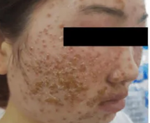 Sốc với mảng mụn chi chít trên mặt cô gái sau dùng bột rửa mặt mua online