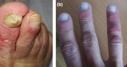 5 dấu hiệu trên da cảnh báo bạn có nguy cơ mắc Covid-19