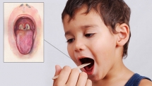 Những điều cần biết về bạch hầu - căn bệnh có thể gây tử vong trong 6 ngày