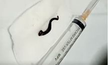 Tưởng viêm họng hóa đỉa ký sinh