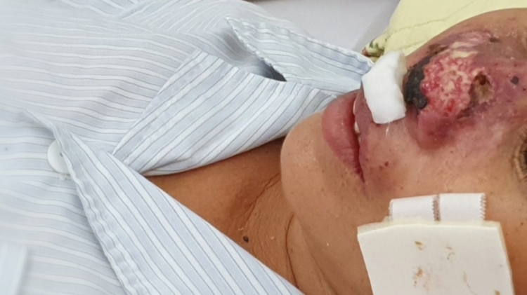 Vi khuẩn ăn cánh mũi tấn công, 4 người mất mạng