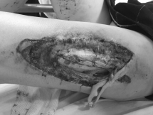 Nữ cổ động viên dính pháo sáng tại sân Hàng Đẫy tổn thương sâu, lộ xương đùi