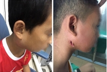 Thêm 3 trẻ em nhiễm vi khuẩn ăn thịt người Whitmore