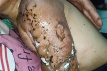 Nhiễm trùng vết bỏng do tự đắp thuốc nam chữa bệnh