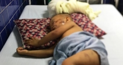 Bị chó becgie nặng 38 kg tấn công, bé trai 2 tuổi nhập viện cấp cứu