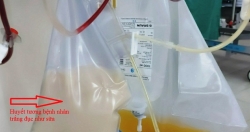 Bệnh nhân bị viêm tụy cấp, huyết tương trắng như sữa