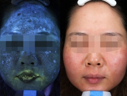 canh bao ve kem tron tri nam chua chat lam trang huynh quang