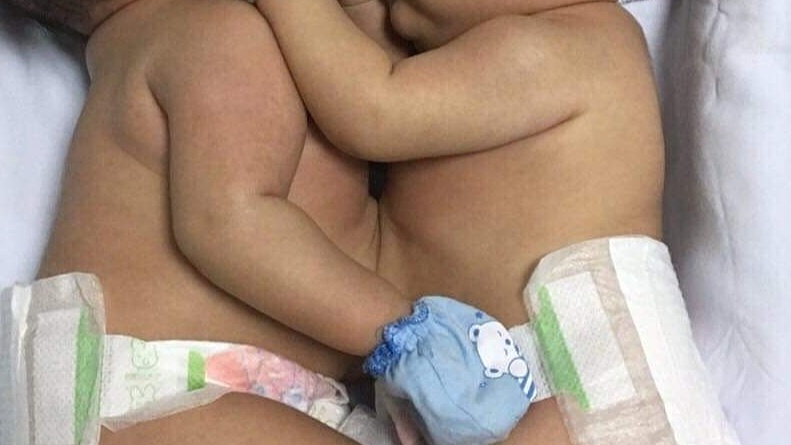 Mổ tách cặp song sinh dính nhau ở gan