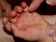 Thuốc chống virus “chữa khỏi” bệnh tay chân miệng?