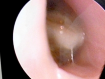 Trẻ nhỏ sổ mũi hôi - Coi chừng có dị vật trong mũi