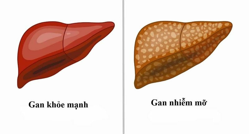 Gần 30 triệu người Việt bị gan nhiễm mỡ