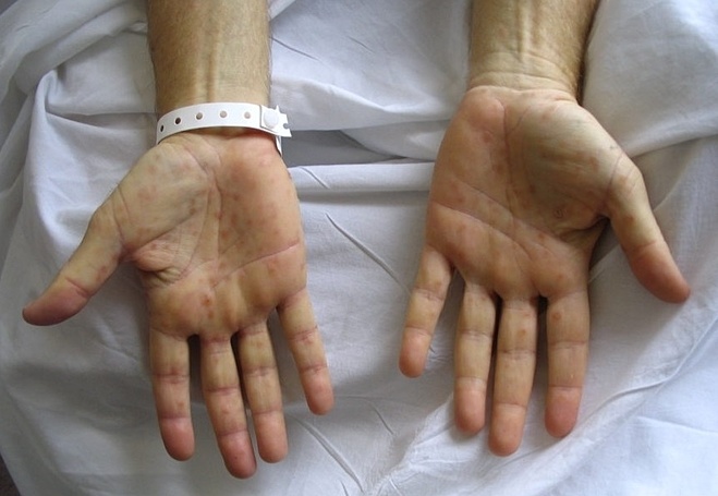 Con chào đời bị giang mai, mẹ mới biết mắc bệnh