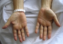 Con chào đời bị giang mai, mẹ mới biết mắc bệnh